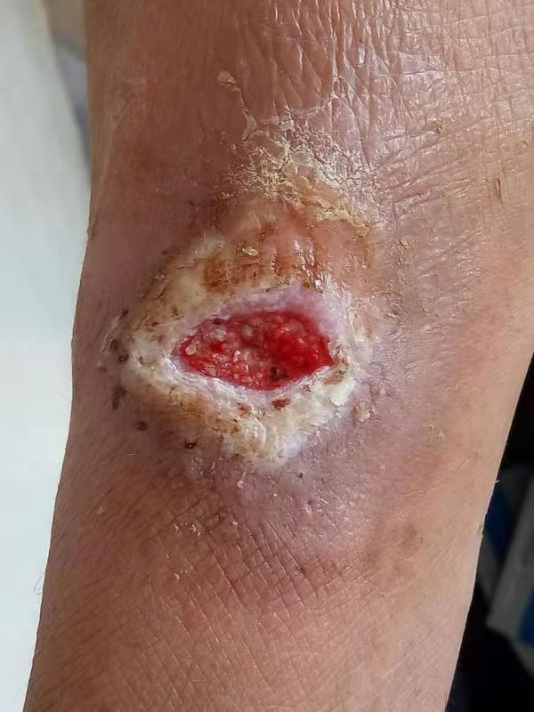 医疗器械例证治疗后